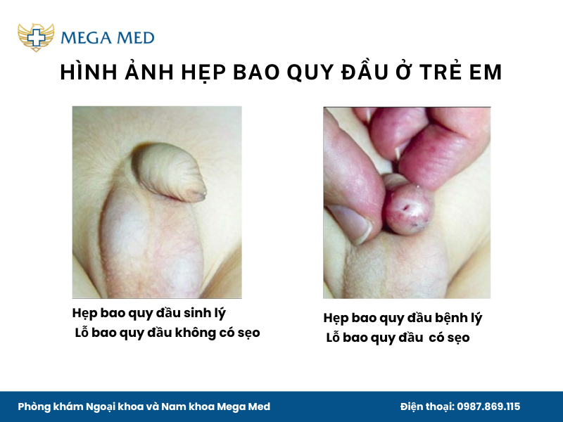 Hình ảnh hẹp bao quy đầu sinh lý và hẹp bao quy đầu bệnh lý ở trẻ em